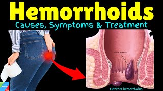 Hemorrhoids  Haemorrhoids  Piles  Hemorrhoidal Disease – Signs amp Symptoms Causes Treatment [upl. by Aneerehs]