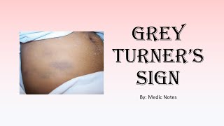 Grey turner sign  causes pathophysiology sign value [upl. by Nodnart721]