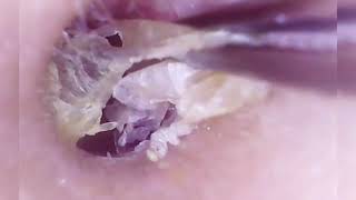 Ear Wax Removal  Deep Cleaning for Ultimate Relaxation 14 [upl. by Coster]