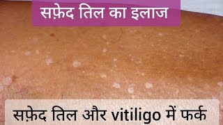 Idiopathic Guttate Hypomelanosis IGH सफ़ेद तिल और Vitiligo  Leucoderma और IGH vitiligo leucoderma [upl. by Ainala]