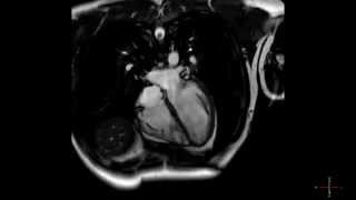 Cardiac MRI scan of a heart beating in high resolution  ECG gated CMRI in HD  real time scan [upl. by Lerrej]