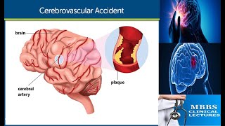 Cerebrovascular Accident CVA1 [upl. by Treblih]