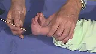 321  Reflexes Plantar Reflex  Newborn Normal  Infant Clinical ExaminationMRCP [upl. by Asik]