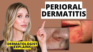 Dermatologist Explains Perioral Dermatitis What it Looks Like Causes amp Treatments  Dr Sam Ellis [upl. by Wilinski]