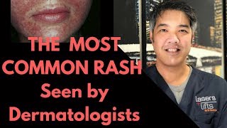 How to treat Perioral Dermatitis Dermatologist Explains [upl. by Chiang]