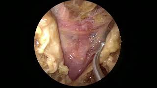 Posterior fossa transnasal exposure [upl. by Chappell]