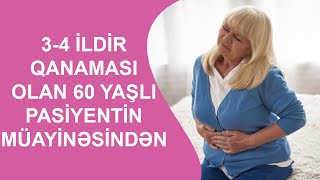 34 İLDİR QANAMASI OLAN 60 YAŞLI PASİYENTİN MÜAYİNƏSİNDƏN [upl. by Einnad]