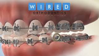 Elastics  Wired Orthodontics [upl. by Joliet]