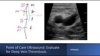 Point of Care Ultrasound POCUS  Evaluating Deep Vein Thrombosis [upl. by Susanne97]