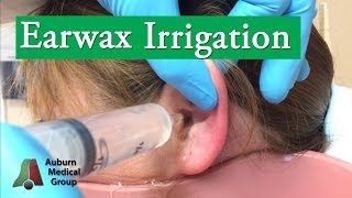 Ear Wax Irrigation  Auburn Medical Group [upl. by Ramoj]