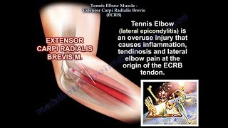 Tennis Elbow Extensor Carpi Radialis Brevis Everything You Need To Know  Dr Nabil Ebraheim [upl. by Nerrat279]