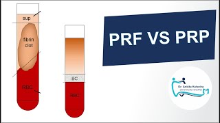 PLATELET RICH PLASMA PRP vs PLATELET RICH FIBRIN PRFSUMMARYPROPERTIESTECHNIQUE DR ANKITA [upl. by Ira]