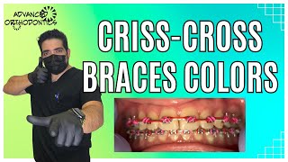 CrissCross Braces Colors [upl. by Tobin]