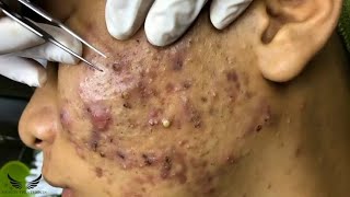 Blackhead Removal  Acne Cystic Treatment  Facial Spa Pimple Popping  Elderly Hidden Acne  076 [upl. by Carlton]