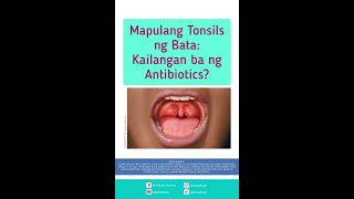 Mapulang Tonsils ng Bata Kailangan ba ng Antibiotics [upl. by Annanhoj]