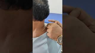 Dry needling [upl. by Pravit]