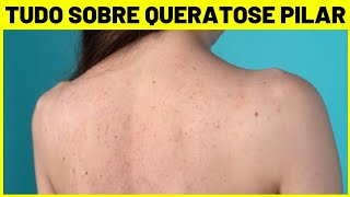 O QUE É QUERATOSE PILAR SINTOMAS CAUSAS E TRATAMENTO [upl. by Neelram602]