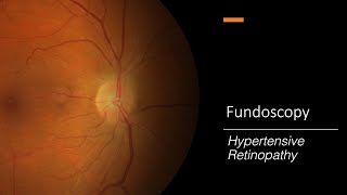 Hypertensive Retinopathy Fundoscopy [upl. by Claudelle]