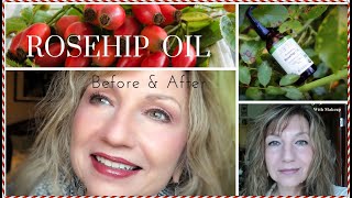 Rosehip Seed Oil  My 4 Year Results w Pictures Before amp After  How To Use For AntiAging [upl. by Meara517]