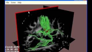 Exploration of the Brains White Matter Pathways with DTIQuery [upl. by Canica]