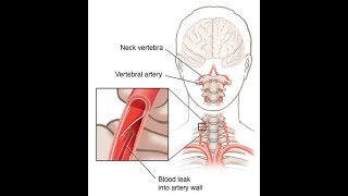 Applied or clinical anatomy of vertebral artery  Occlusion to branches of vertebral artery [upl. by Leta]