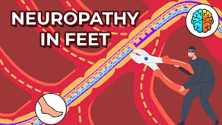 Dealing with Neuropathy in Feet Causes Symptoms and Treatments [upl. by Bar]