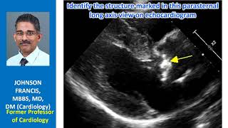 Identify the structure marked in this parasternal long axis view on echocardiogram [upl. by Aicenek]