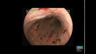 Hemorrhagic Gastropathy [upl. by Barnabas167]