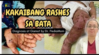 KAKAIBANG RASHES sa BataGalis at MamasoDiagnosis at Gamot Dr Pedia Mom [upl. by Lannie]