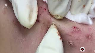 Big Cystic Acne Blackheads Extraction Blackheads amp Milia Whiteheads Removal Pimple Popping [upl. by Noe]