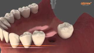 ETIII Fixture amp Rigid Abutment  Surgical amp Prothesis Sequence [upl. by Pascia]