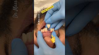 Tooth fracture Extraction Dental Implant after 4 months viralvideo shorts l [upl. by Alburg]