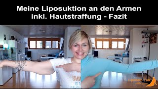 Meine Liposuktion an den Armen inkl chirurgischer Hautstraffung  Fazit [upl. by Dulciana]