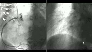 Coronary CT Angiography Cath [upl. by Kenison]