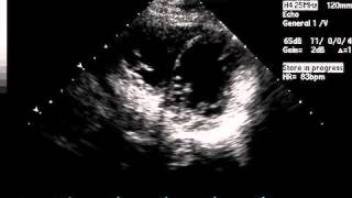 Two Videos Showing the Results of Transthoracic Echocardiographic and Cardiac MRI Studies [upl. by Aziaf302]