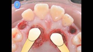 CBCT amp Impacted cuspids1 [upl. by Anihpled]