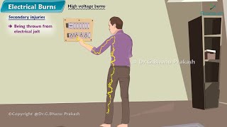 4 Burns Part4  Electrical Burns and Post Burn Neck Contractures [upl. by Eirrok292]