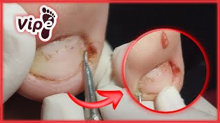 PODOLOGIA EM UNHA ENCRAVADA OVERGROWN INFECTED INGROWN TOENAIL REMOVAL [upl. by Annairba]