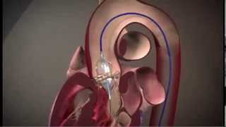 Edwards SAPIEN Transcatheter Heart Valve with the RetroFlex 3 Transfermoral System TAVR [upl. by Negeam]