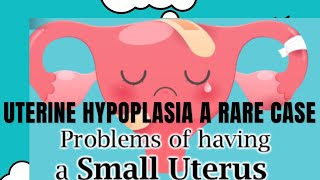 Uterine Hyoplasia A rare case🔙🔙🔙 [upl. by Binnings]