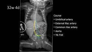 Umbilical Arterial Catheters UACs  Pediatric Radiology and NICU [upl. by Droffig347]