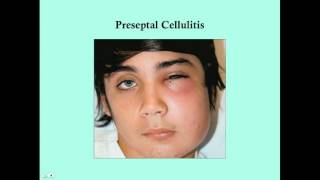 Preseptal and Orbital Cellulitis  CRASH Medical Review Series [upl. by Norred]