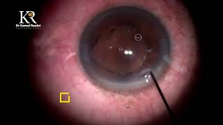 Uveitic cataract with tough pupillary fibrosis [upl. by Emolas763]