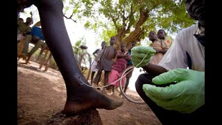 नारू या आजाराबद्दल माहिती गिनी वर्म Guinea Worm [upl. by Erma]