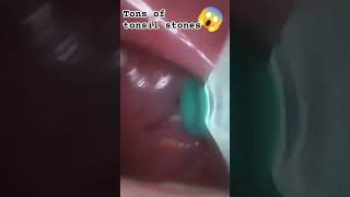 TONS of tonsil stones in that spot 😱 tonsilstones tonsils tonsilolitos gross tonsilloliths [upl. by Hesky]