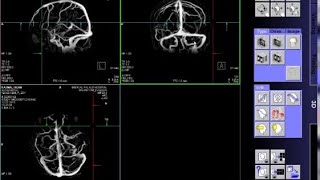 İlacli Beyin Venografi MR Nasıl Çekilir MR  Emar  Nasıl ÇekilirBeyin Damarlari Görüntüleme [upl. by Ennis]