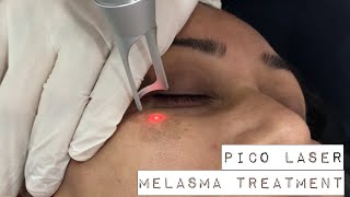 Melasma treatment with PICO Laser [upl. by Aubrie160]