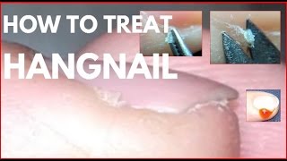 How to treat hangnails Agnail treatment [upl. by Marrissa858]