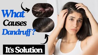 Top Reasons For Dandruff amp How To Fix It Naturally ✨ 😌 [upl. by Nelrac]