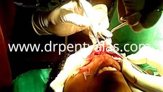 Feminizing Rhinoplasty Reshaping nose surgery  DrPentyalas [upl. by Gredel762]